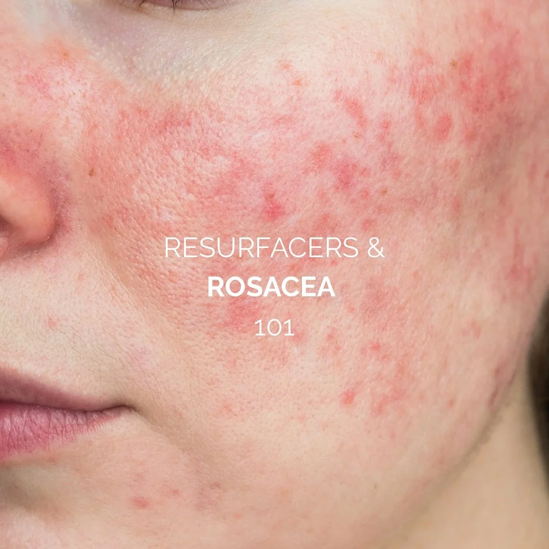 Did you know that resurfacers (superficial chemical peels) can support rosacea-prone skin?

When performed correctly, gentle peels (like lactic or mandelic acid) can:

✔️ Reduce surface redness
✔️ Calm inflammation
✔️ Improve skin texture
✔️ Boost pr