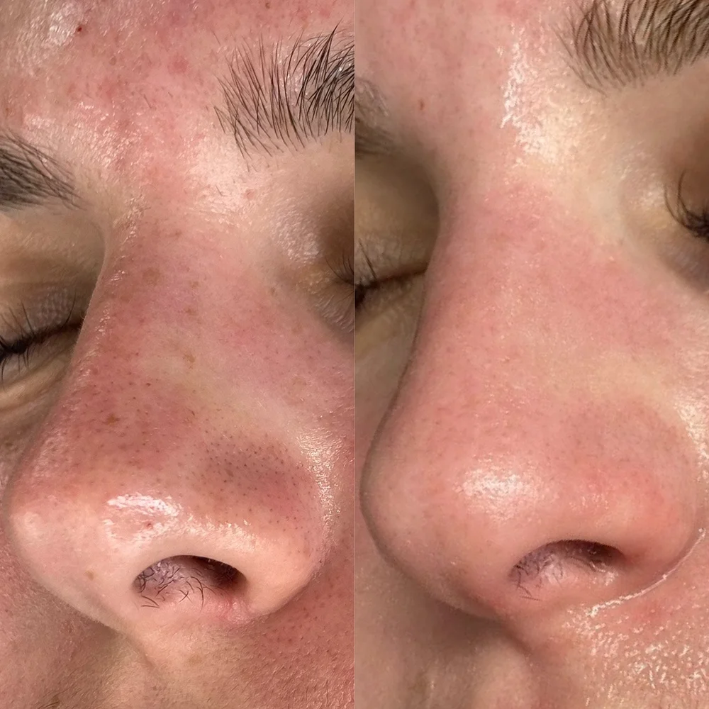 Blackhead Extraction Facial | Facial Telford | Hydrafacial Extraction ...