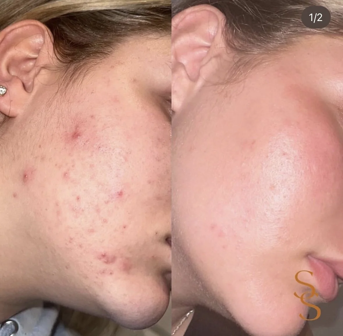 acne facial near me​, best facial for acne​