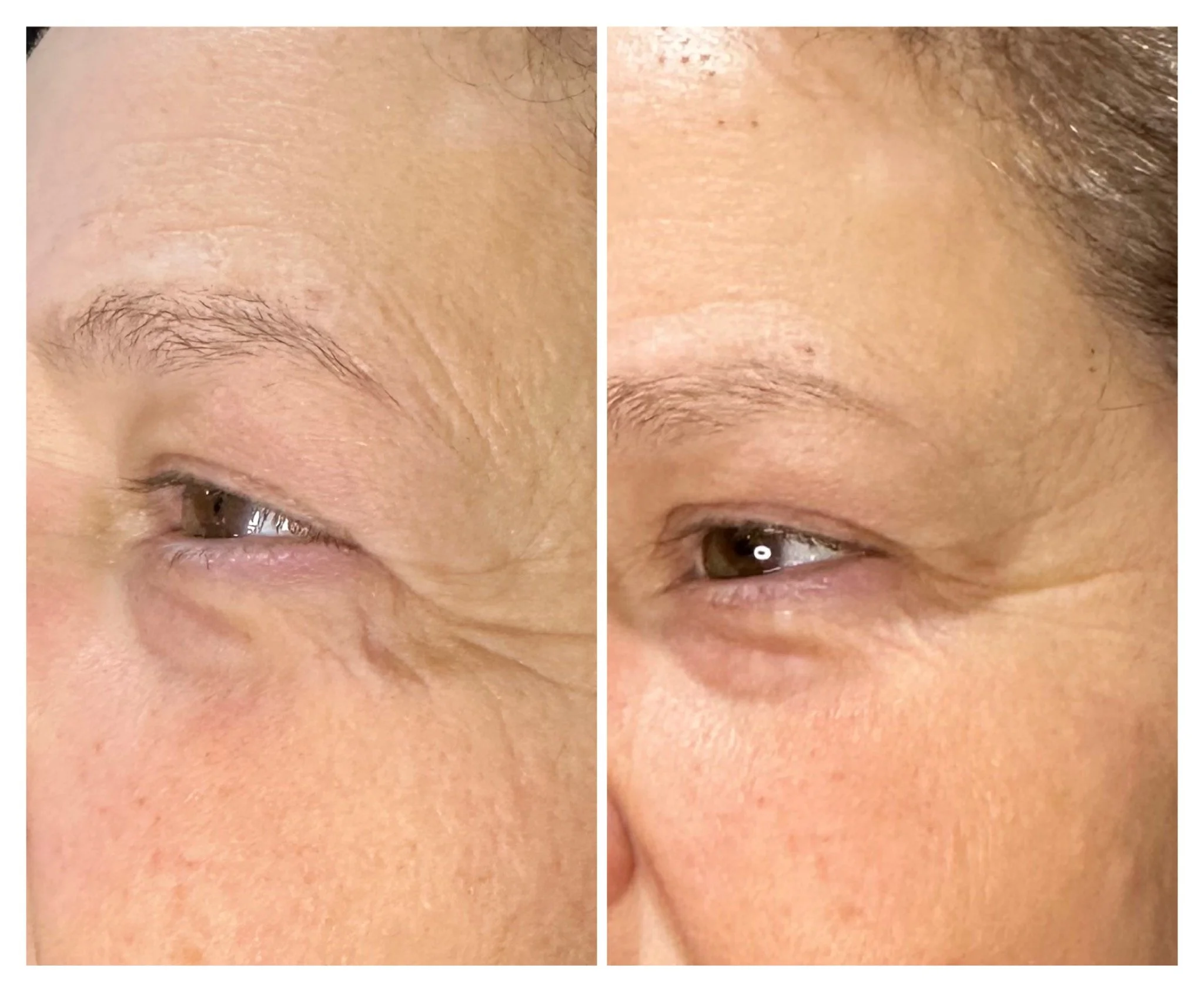 Fibroblast Plasma Skin Rejuvenation