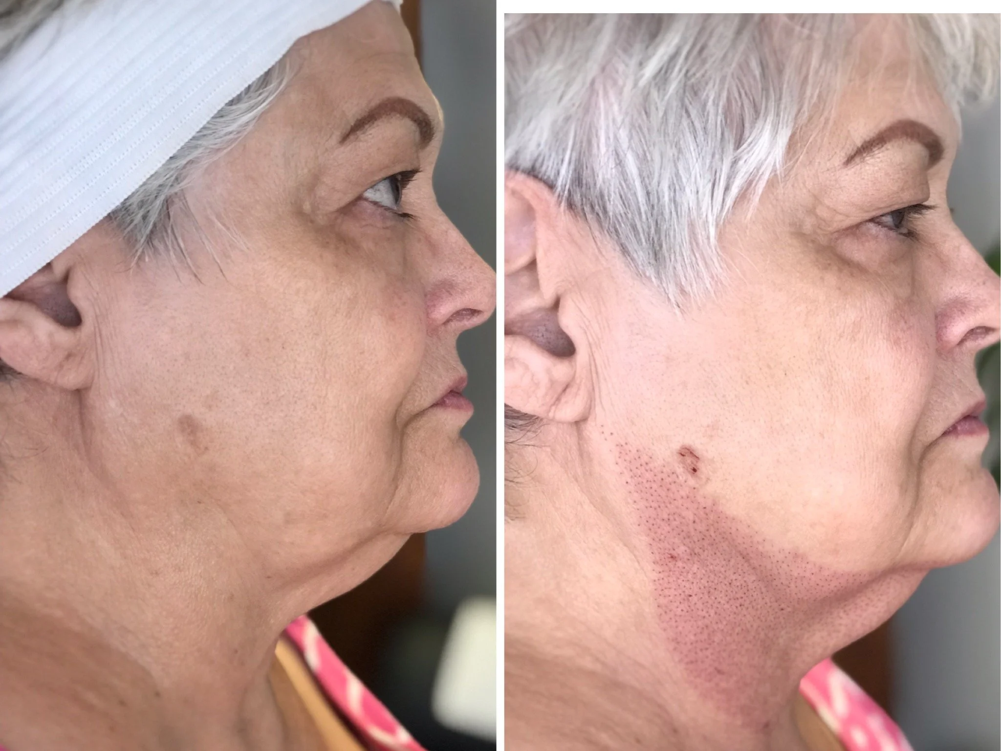 Immediately following treatment on neck.