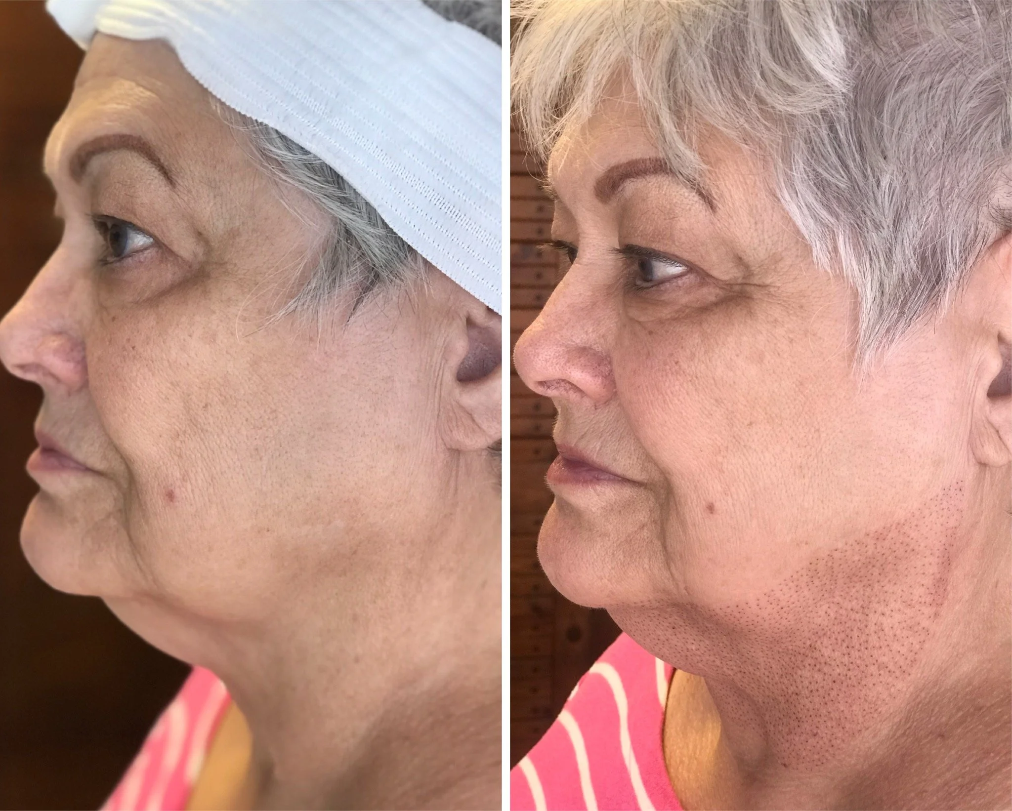 Immediately following treatment on neck.