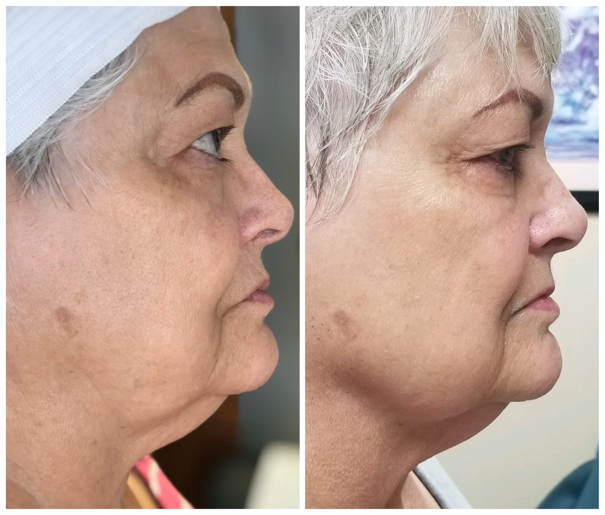 Two weeks post treatment.