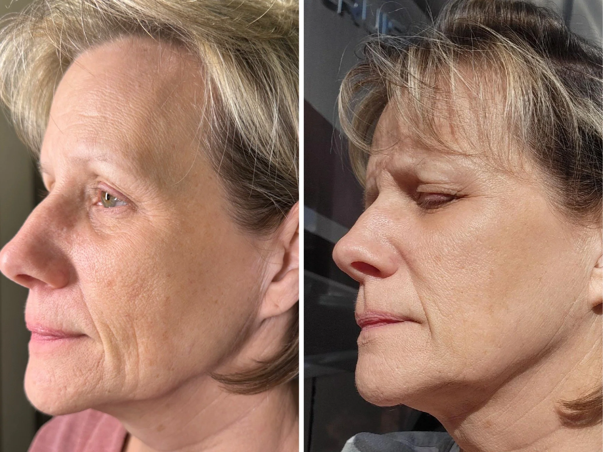 Two Months Post Treatment