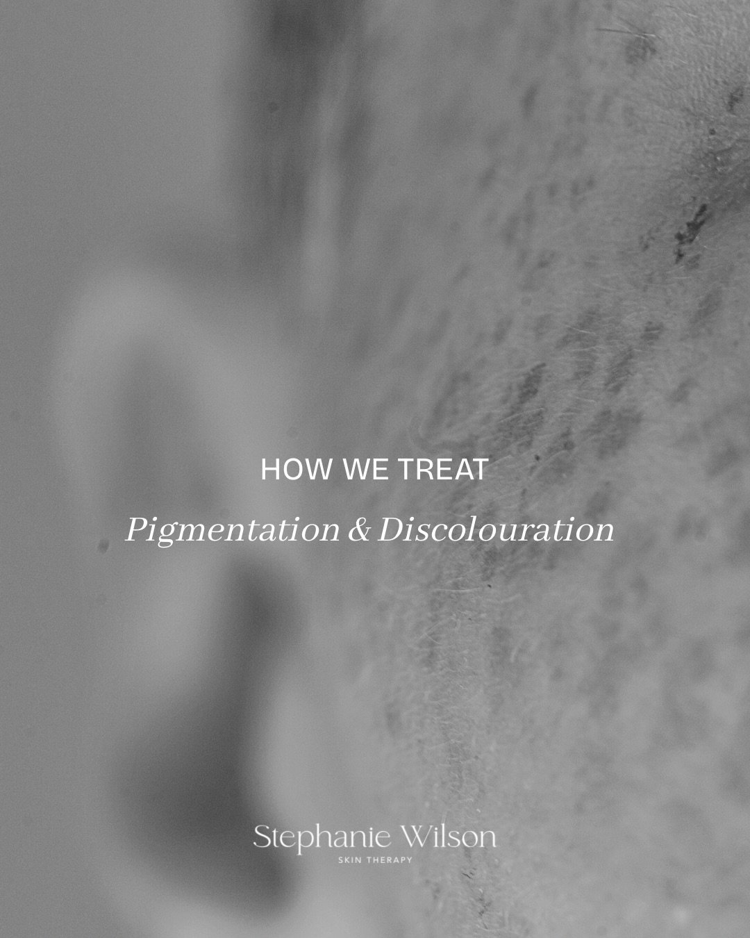 At Skin Therapy we understand the complexities of treating discolouration in the skin, particularly during the summer months

With a variety of treatment options available, depending on the type of pigment that requires targeting, we have solutions f