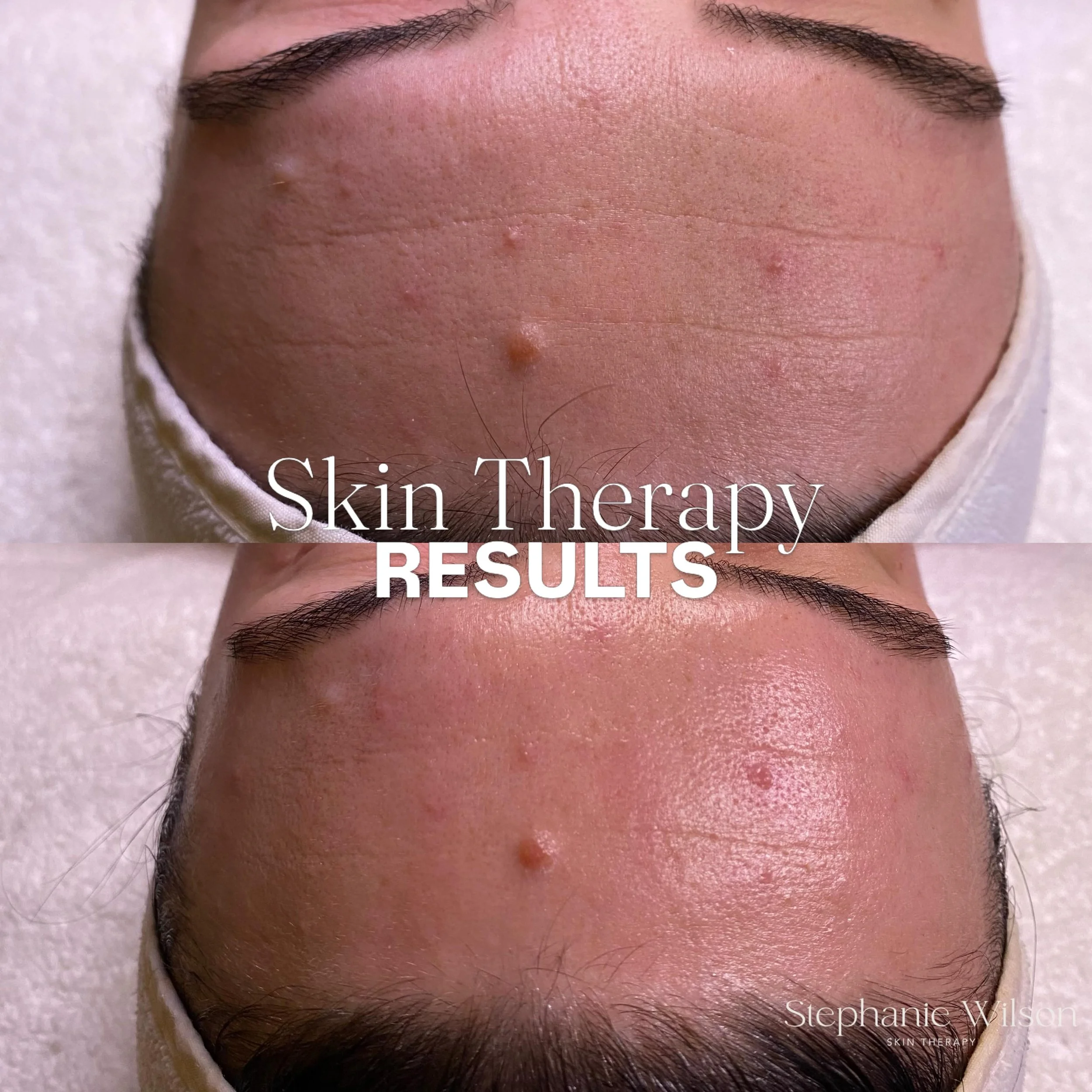 Every thing that you dont like on the surface of your skin is your skin trying to defend itself

It&rsquo;s a response to the stress you feel and exposure to your environment

At Skin Therapy we have the tools and the knowledge to bring your skin bac