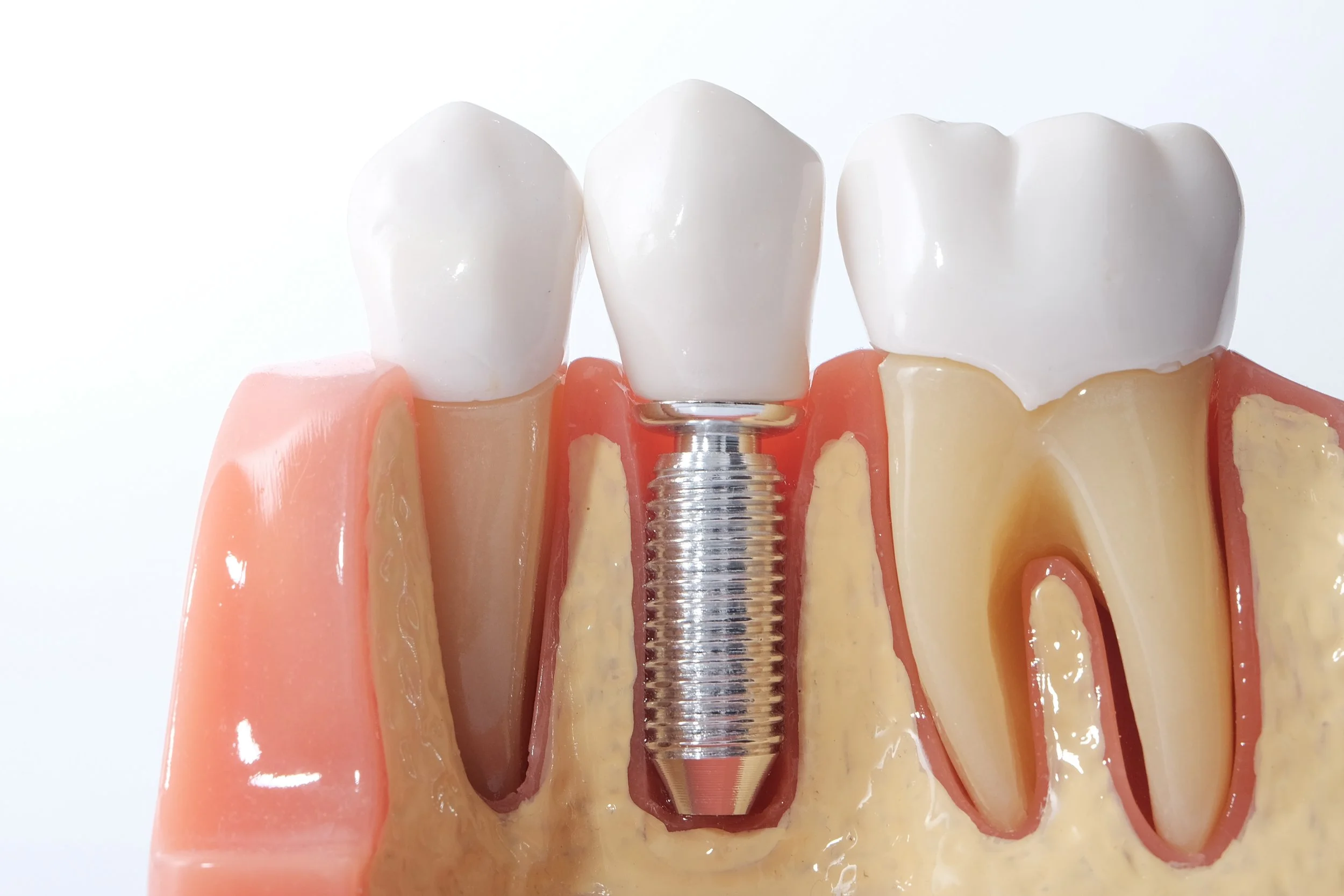 How are implant crowns attached?