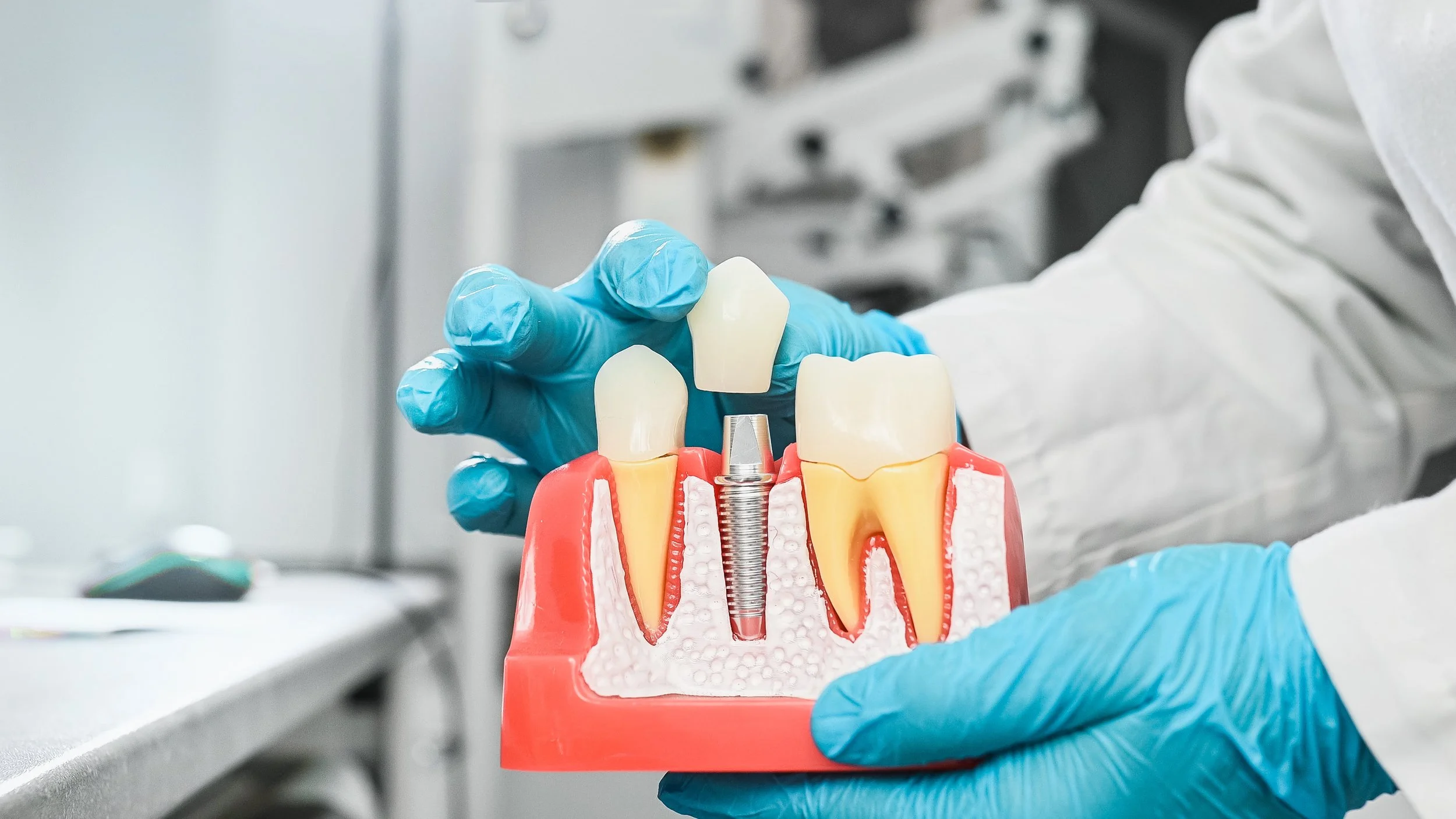 How Long Does a Dental Implant Procedure Take?