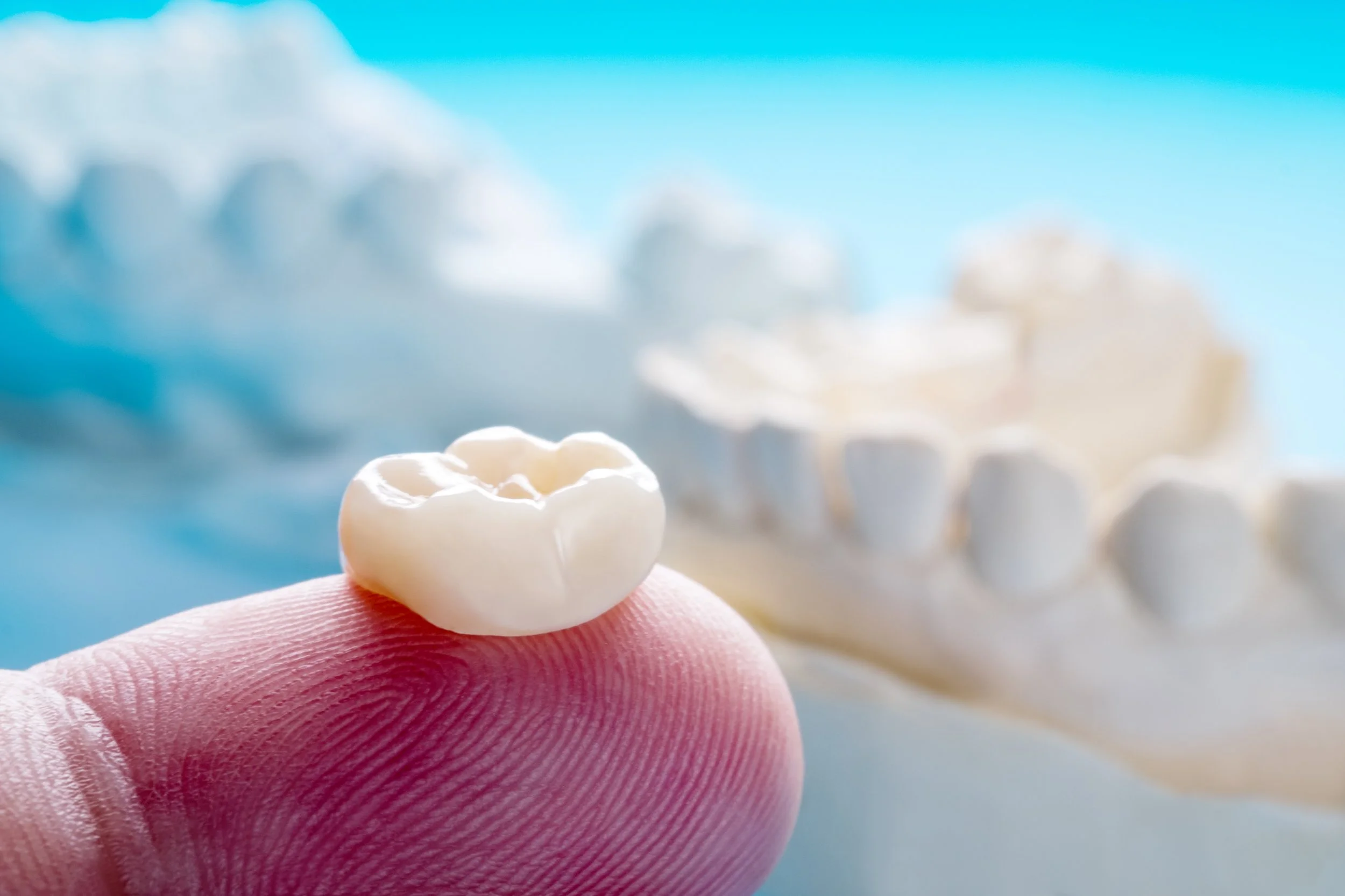 Why Do You Need a Crown After a Root Canal?