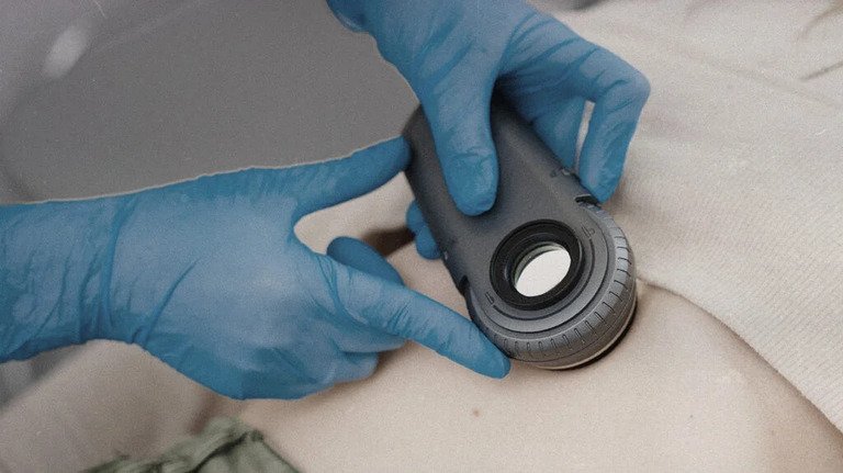 mole dermatascope.jpg