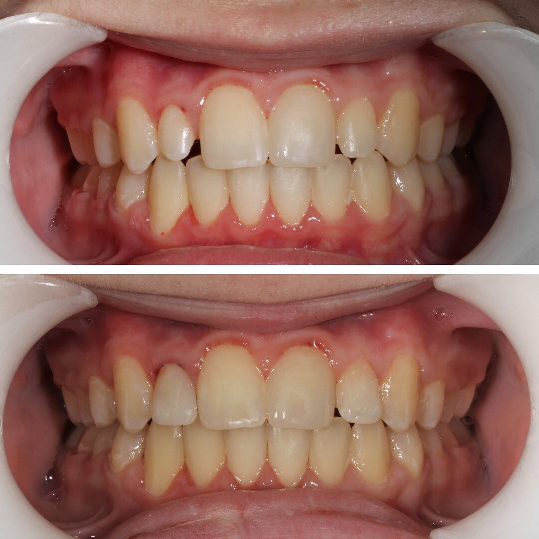 Our 14 year old patient came in looking to improve his post orthodontic smile. Since he's a hockey player and still young, Dr. Kerwar recommended a chair-side composite veneer, which is less invasive than regular veneers for young patients like him. 
