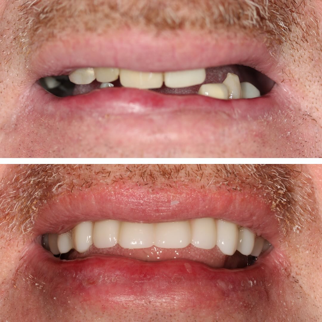 Dr. Pereira, in collaboration with @greenwichoralsurgery and @ndxnsequence, flawlessly delivered implant-supported dentures for our patient who lost teeth in an accident years ago. Swipe to see our patient&rsquo;s happy smile at the end that says eve