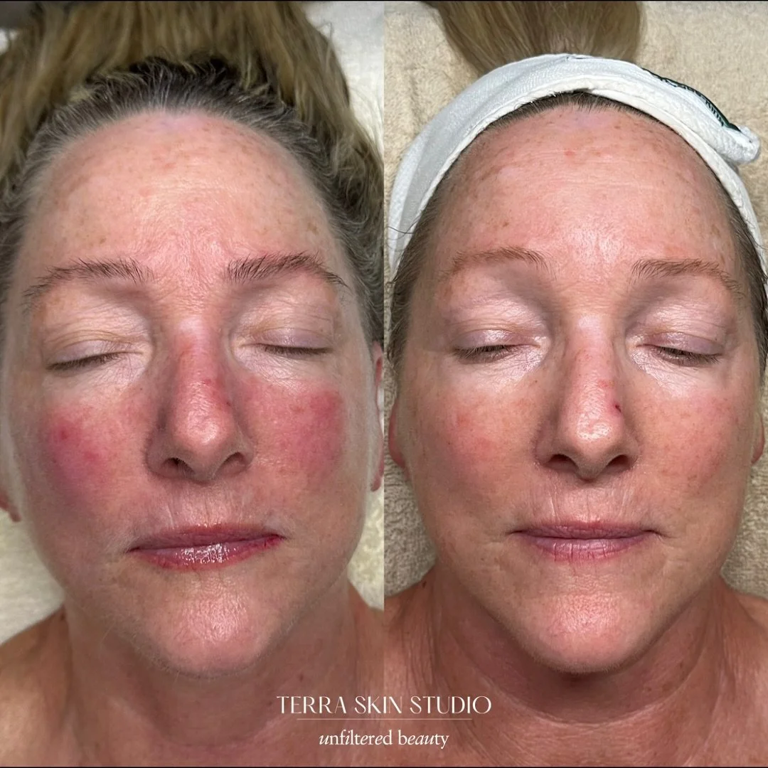 Beautiful results &amp; a healthy skin barrier! This client has been seeing me for healing and corrective facials along with following her personalized skincare regimen. We&rsquo;re both thrilled!! 

🧖&zwj;♀️Our visits include:
Signature Facial II 
