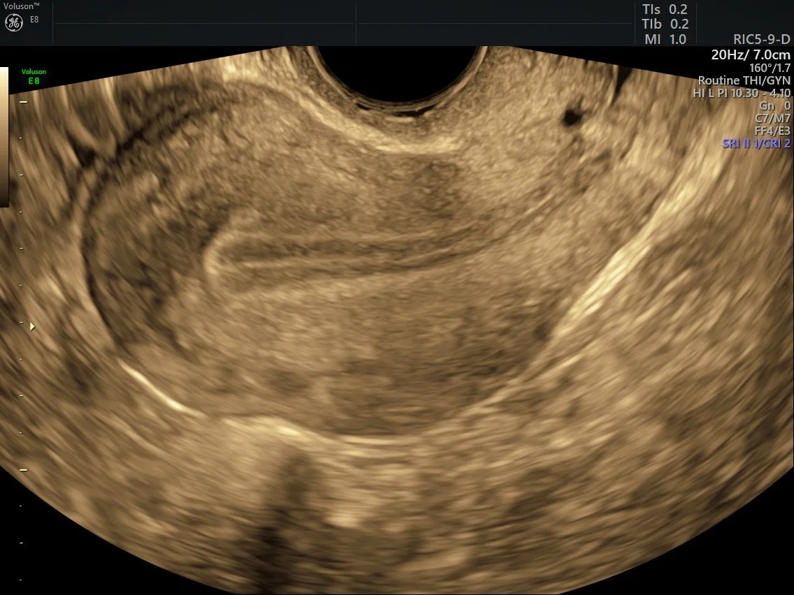 uterus, pelvis, pelvis, pelvic scan, pelvic pain, bleeding, pelvic scan, ovaries, ovarian issues, ovarian, gyaene, gynaecology, gynaecology issues