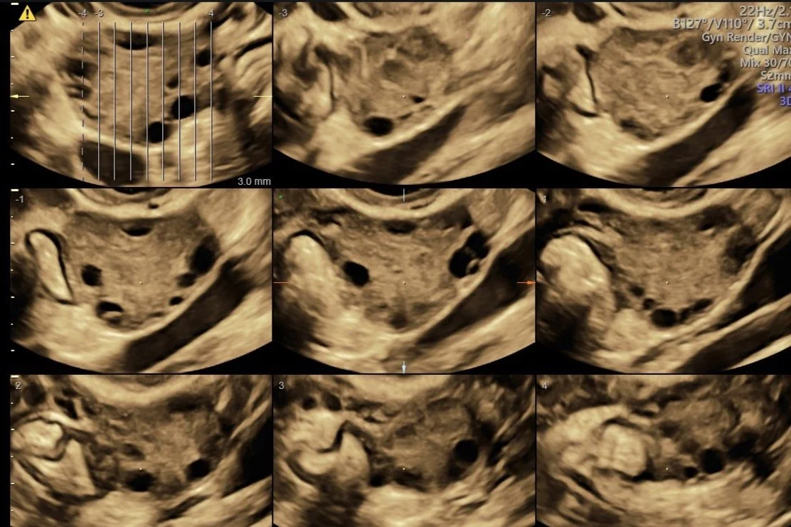 uterus, pelvis, pelvis, pelvic scan, pelvic pain, bleeding, pelvic scan, ovaries, ovarian issues, ovarian, gyaene, gynaecology, gynaecology issues