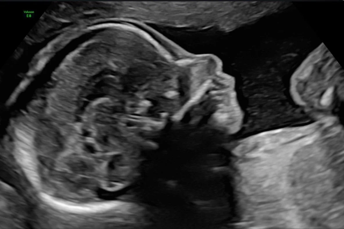 morphology, morphology scan, 20 weeks, 20 weeks scan, check baby, anatomy, anatomy scan, baby well being, well being