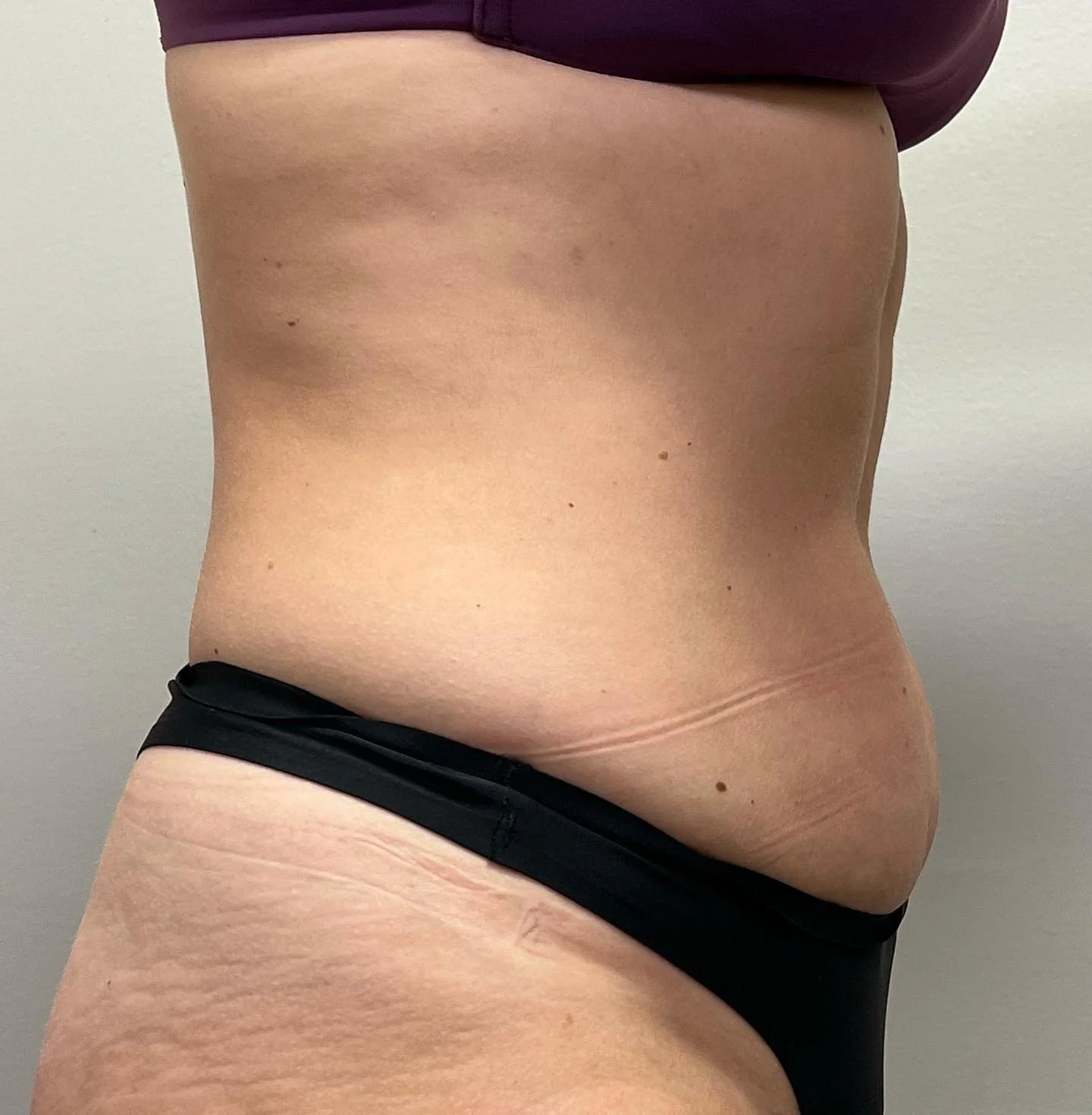 Before and After EMSculpt NEO in South Bend