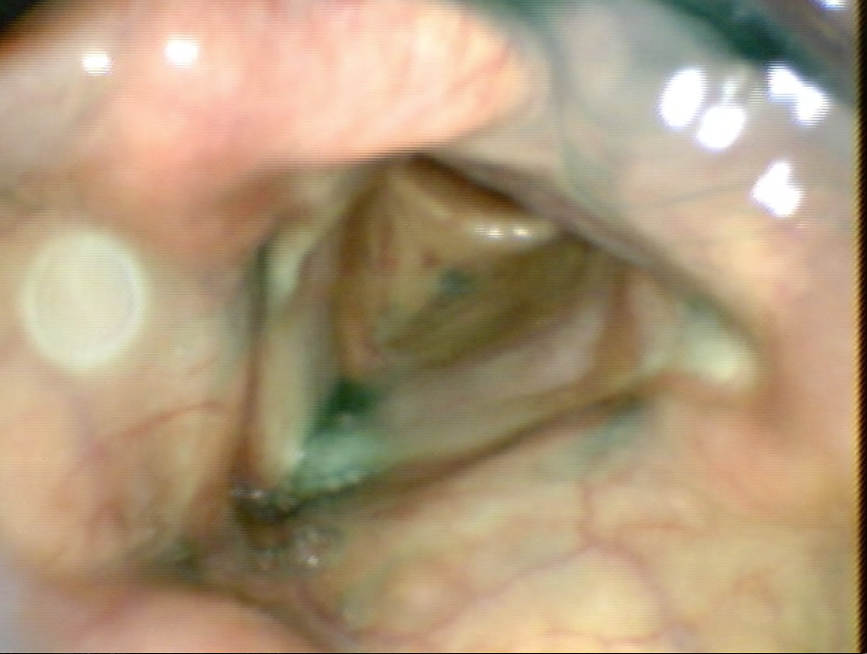 Airway after swallowing - Aspiration