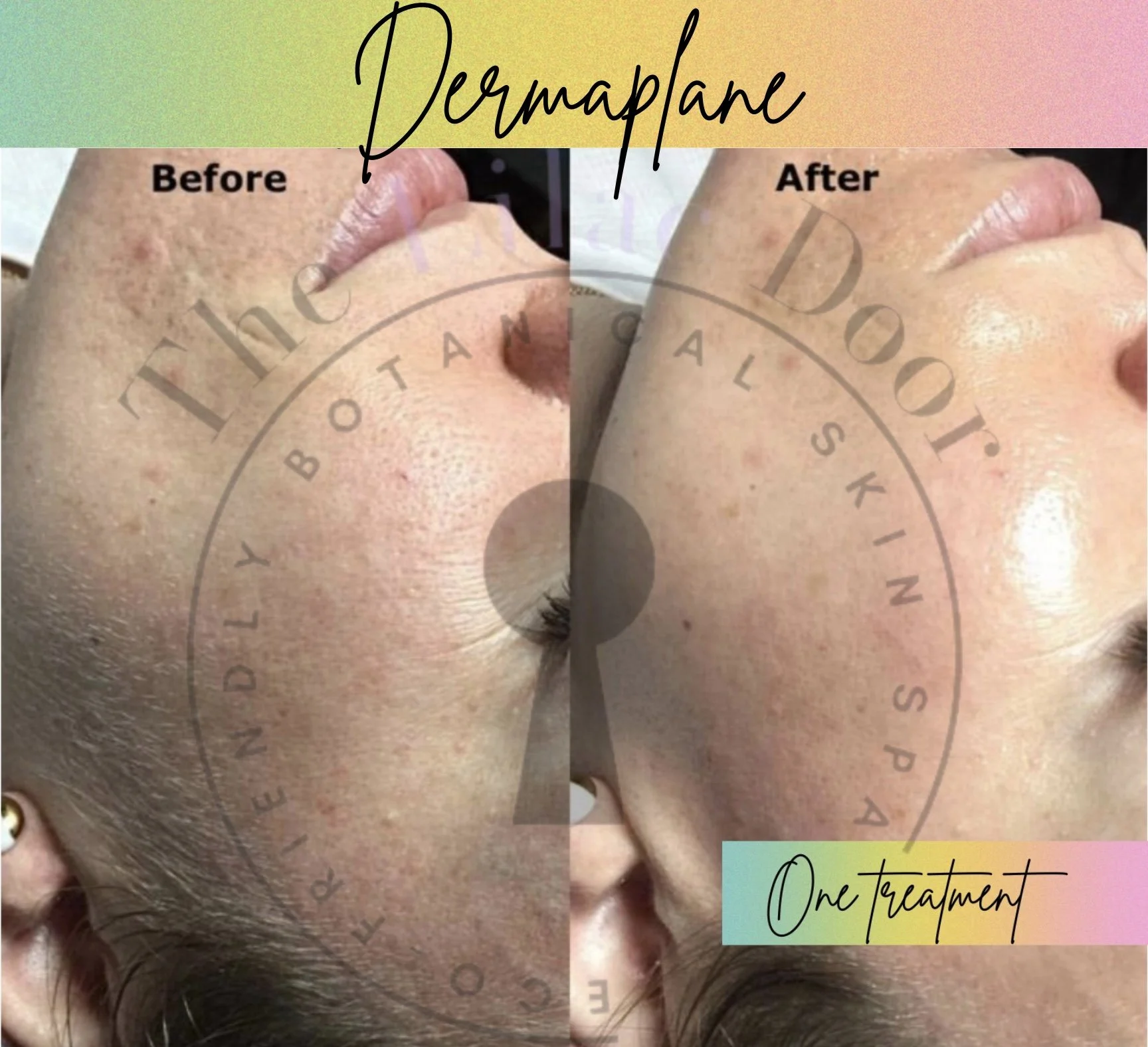 Dermaplane
