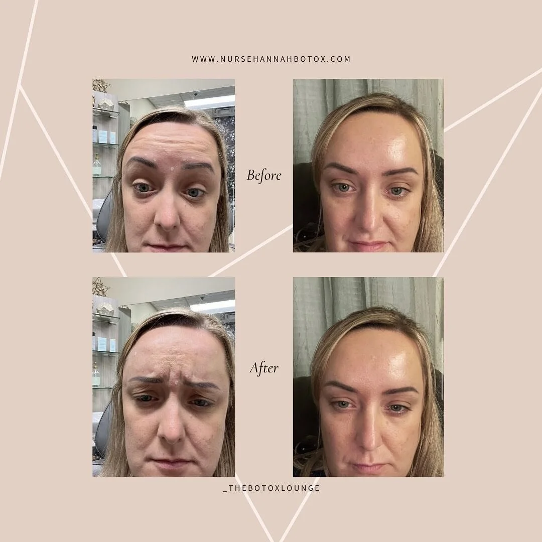 Before &amp; Afters 🙌🏼 
.
.
.
25 Units of Dysport was used to achieve these results. Areas treated are glabella (11 lines/frown lines) and frontalis (forehead lines). Results vary per person
.
.
.
#botox #botoxinjections #botoxface #nurseinjector #