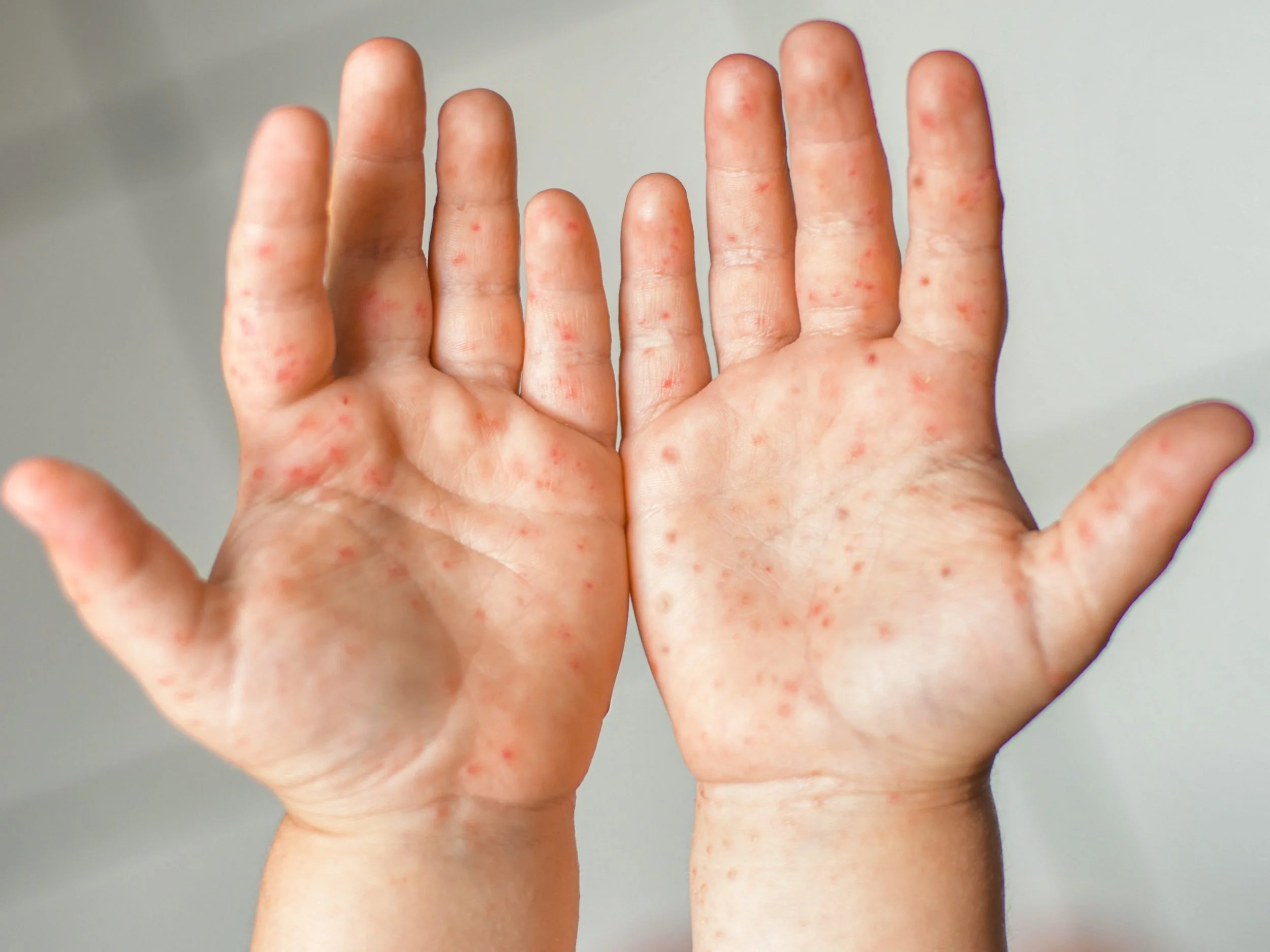 โรคมือ เท้า ปาก ในเด็ก