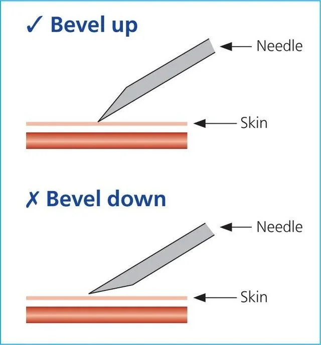 diy-101-needles-what-is-bevel-up-why-its-important-v0-dahn0hkqu70e1.jpeg