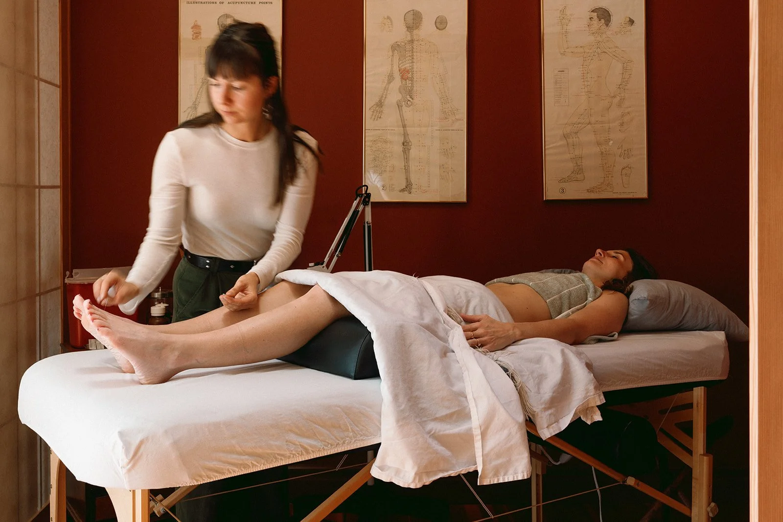 A woman receiving acupuncture on a massage table in a room with acupuncture diagrams on the wall.