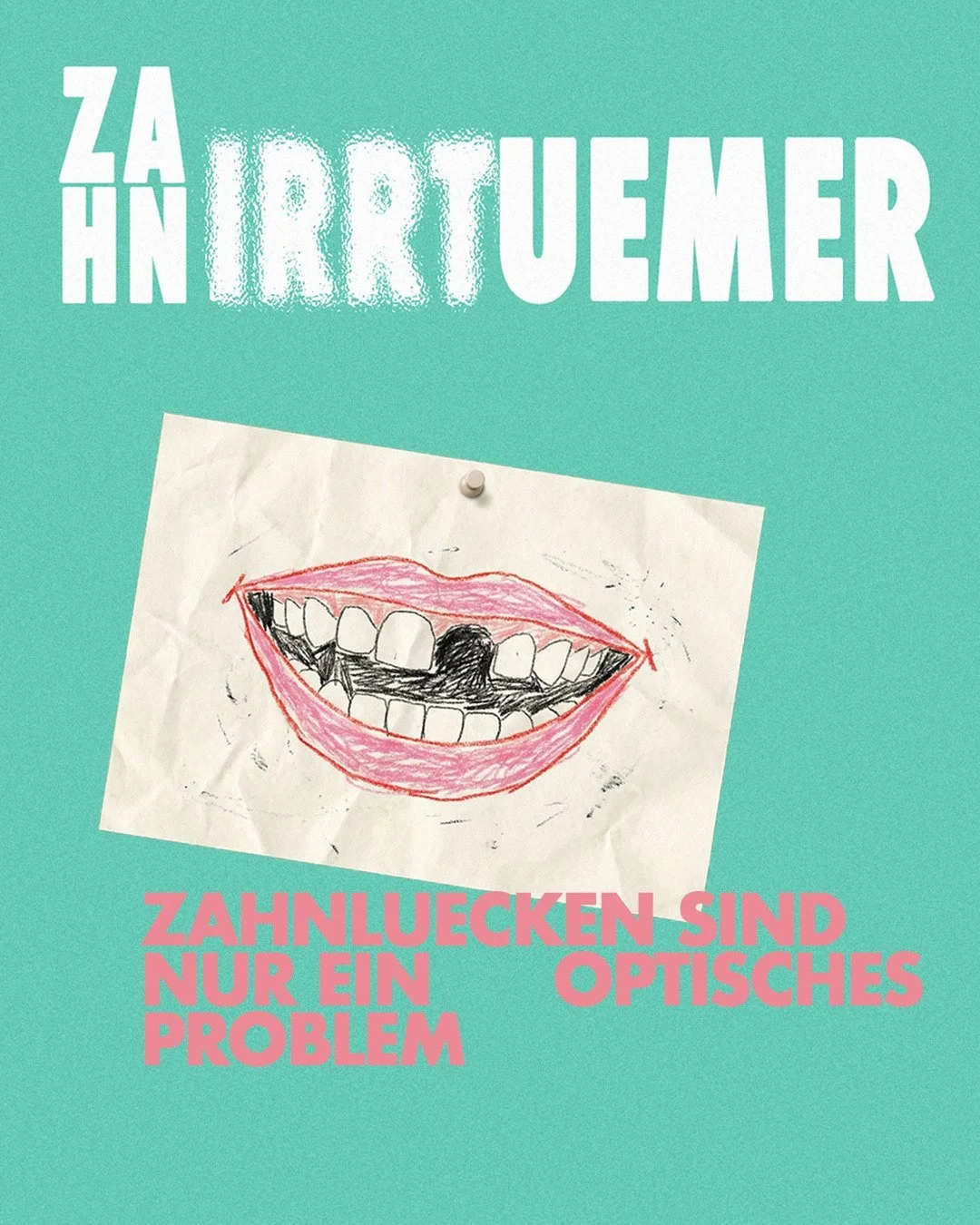 𝐋𝐞𝐢𝐝𝐞𝐫 𝐧𝐮𝐫 𝐞𝐢𝐧 𝐌𝐲𝐭𝐡𝐨𝐬! 🕳️
Viele denken: &bdquo;Eine L&uuml;cke zwischen den Z&auml;hnen st&ouml;rt nur das Aussehen.&ldquo; Tats&auml;chlich kann eine Zahnl&uuml;cke jedoch weitreichende Folgen haben: Sie kann die Kaufunktion beein