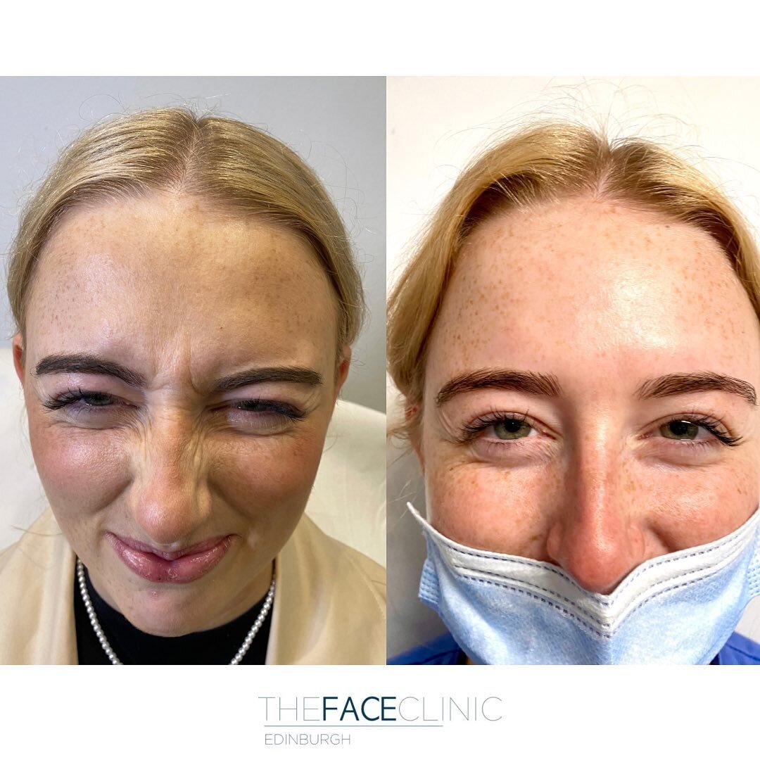 Anti-wrinkle injections can be used to soften early frown lines and help prevent dynamic lines from worsening as we age. 

Results here show maximum frown before and two weeks following anti-wrinkle treatment. 

Book your free consultation with the t