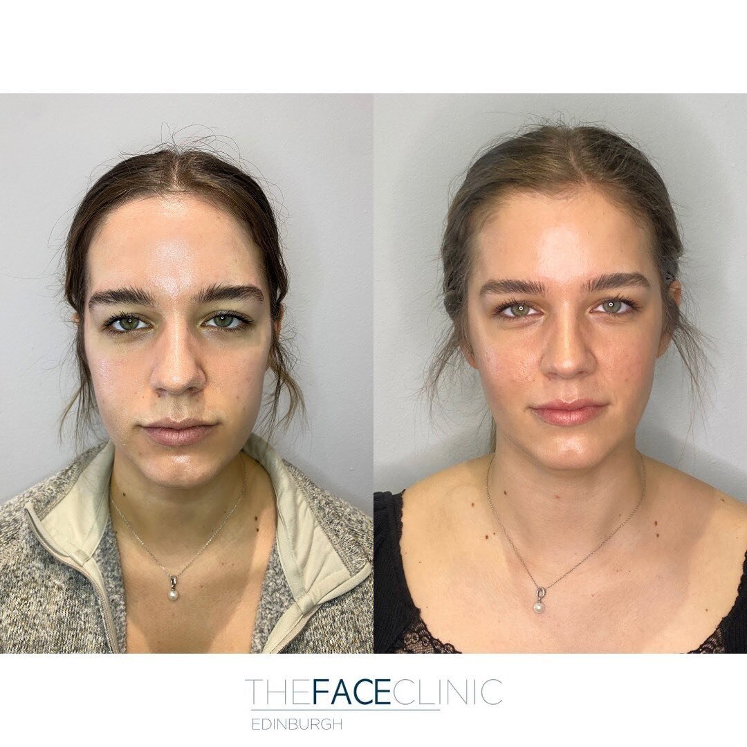 Full face dermal filler and anti-wrinkle treatment

This patient came to see us in preparation for her wedding. Her chief complaint was that she felt she looked tired and had started to notice some early volume loss, however as a newbie to aesthetic 