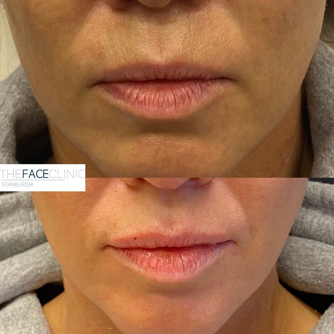 Lip enhancement doesn&rsquo;t need to look &ldquo;fake&rdquo;!

When performed by an experienced aesthetic medical professional, lip enhancement with dermal filler should provide natural rejuvenation and enhancement to the lips and peri-oral structur