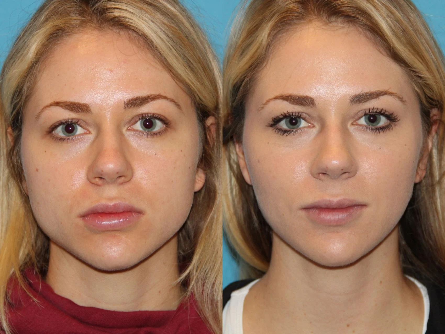 Masseter botox how does facial slimming treatment work? — The Face