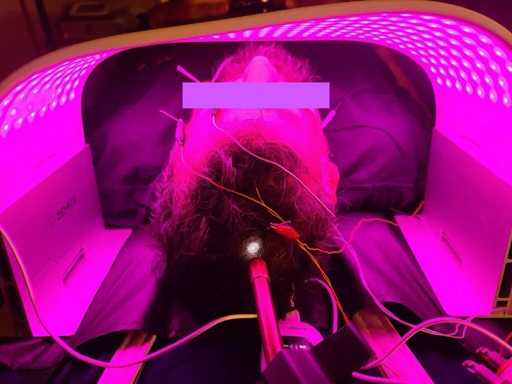 Acupuncture for insomnia; combining Gunalight and red LED