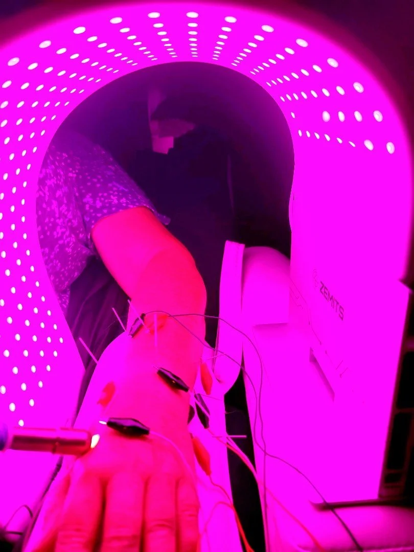 Acupuncture for hand injury; combining Gunalight and Infrared Light