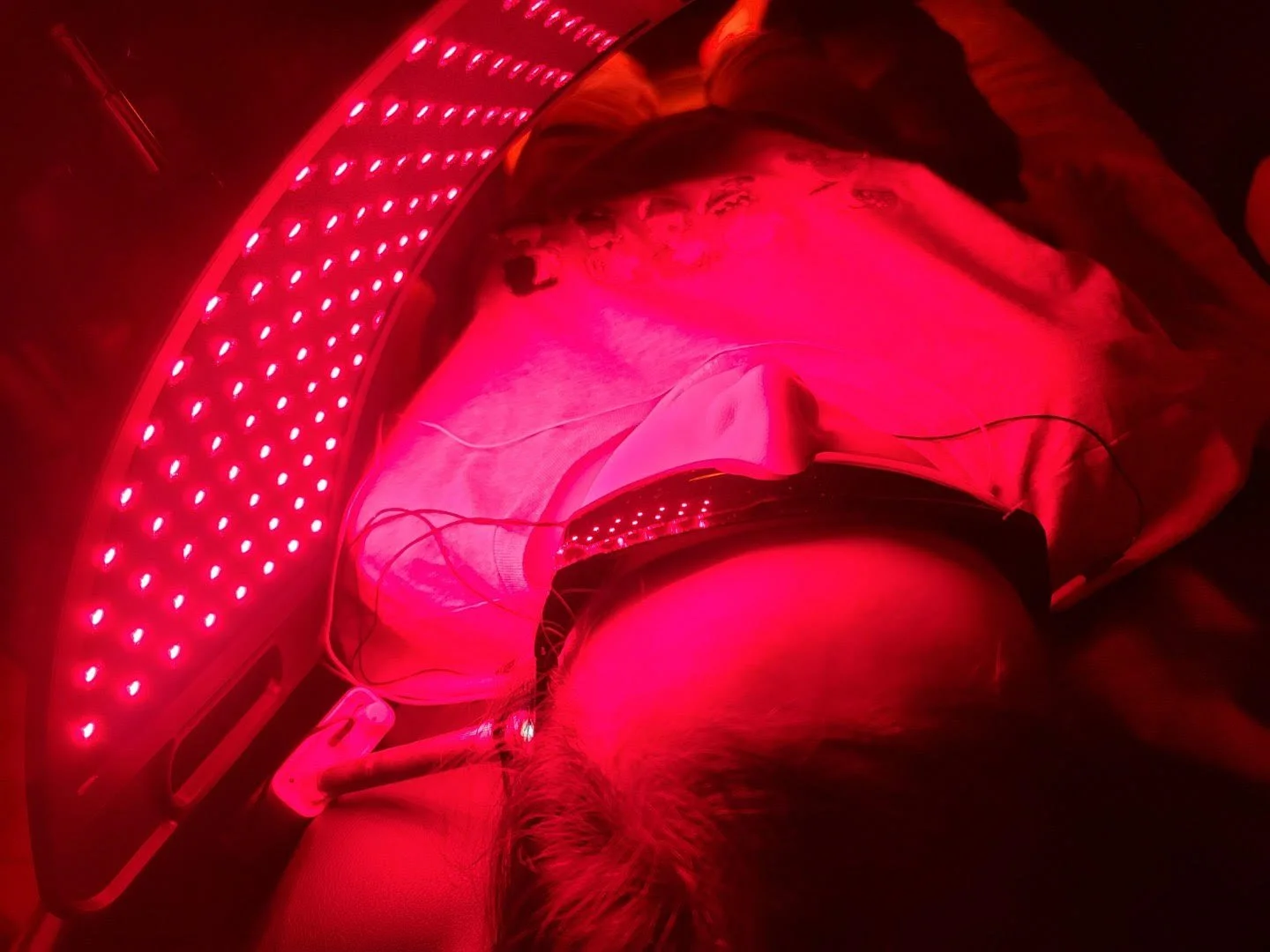 Acupuncture with Gunalight and Infrared Light