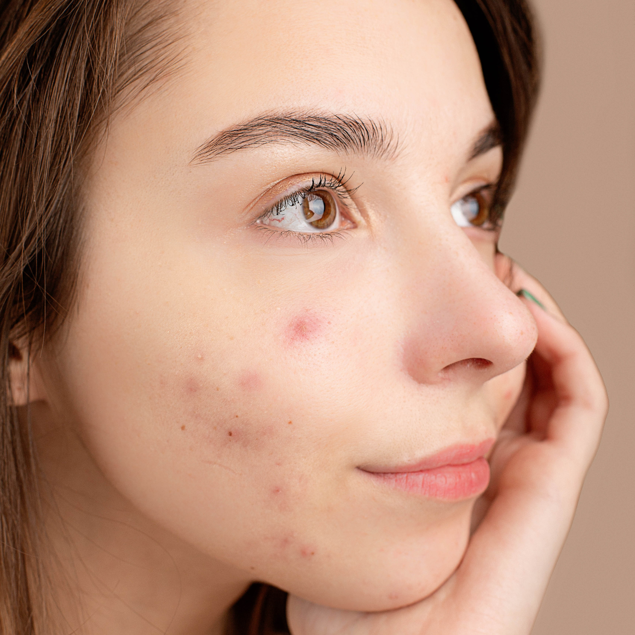Close-up of a young woman's face with acne and clear skin, touching her cheek gently, looking thoughtfully to the side.