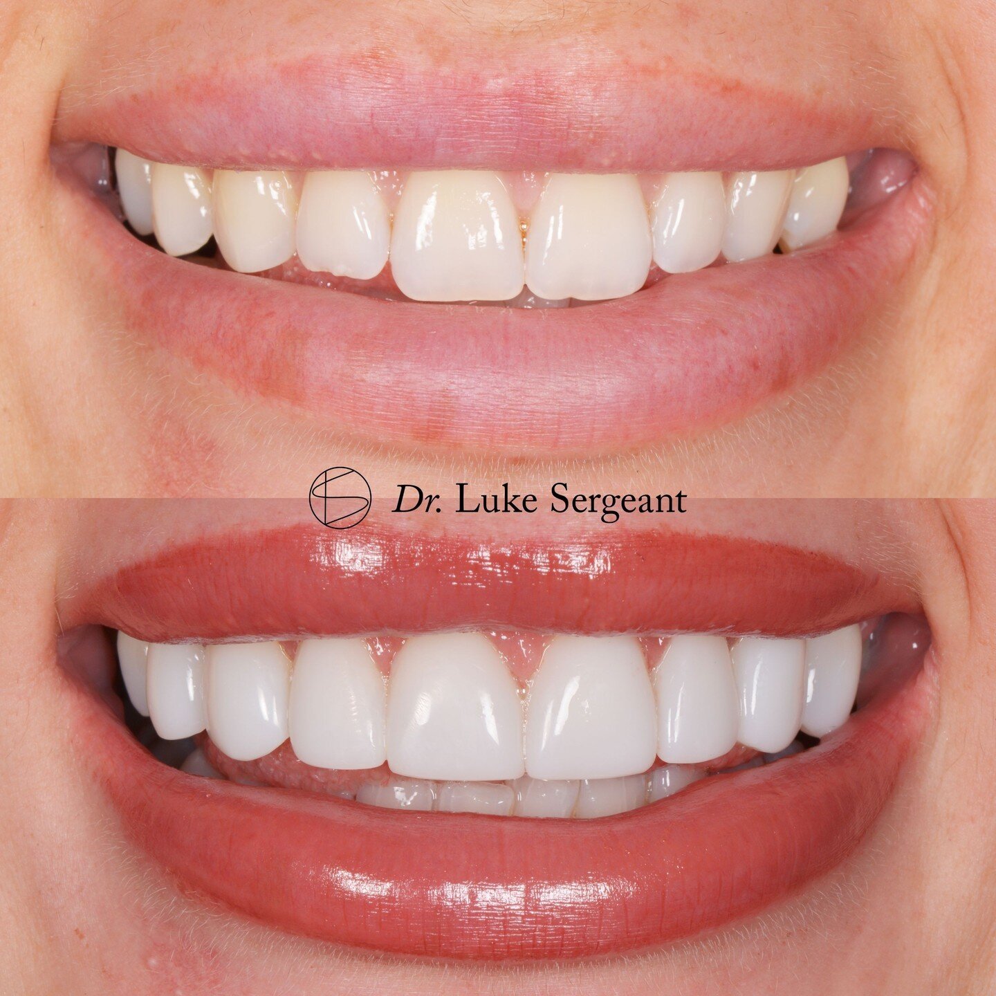 A great composite veneer transformation! Schedule your free smile consultation at Raby Road and let our expert team guide you on your journey to a brighter, healthier smile! ✨

#smilejourney #smiletransformation #wirral #dental #compositeveneers