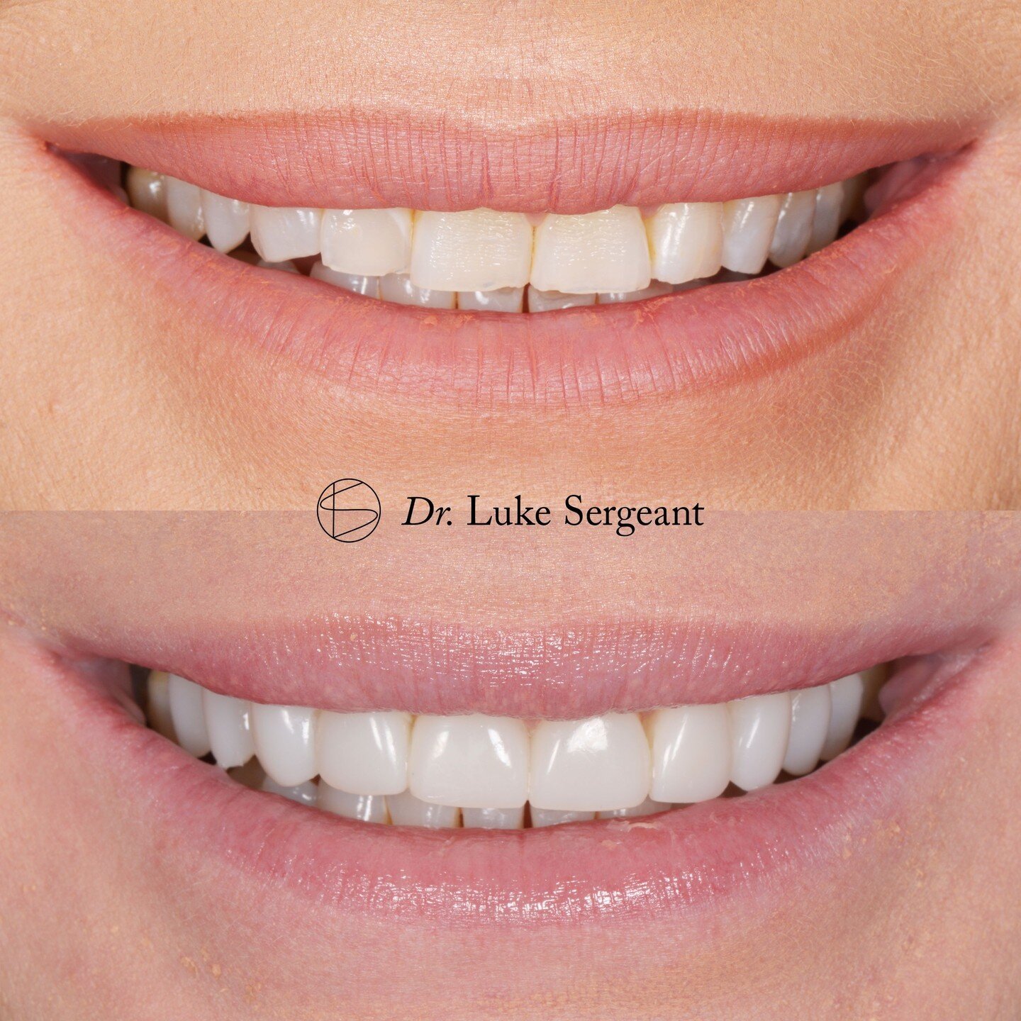This client dreamt of a brighter, more even and symmetrical, fuller smile. We brought this to life with tooth whitening, smile design and 10x composite veneers in &quot;softened&quot; style! ✨

#compositeveneers #smiledesign #smiletransformation