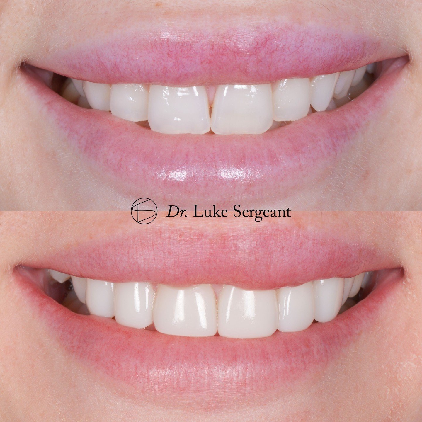 Big changes start with small steps. Our latest client's journey included Invisalign and composite bonding on 6 teeth, leading to a truly great smile. See the difference for yourself. Thinking about a change? Raby Road Dental is here to help. ✨

#comp