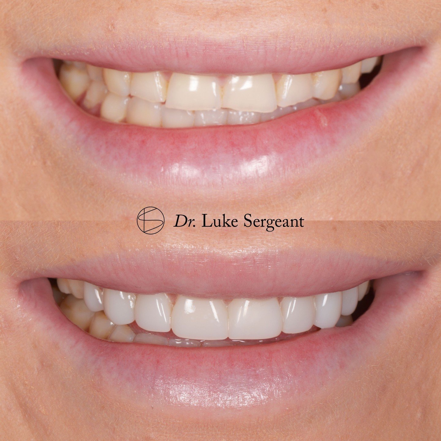 This client had experienced moderate  wear to her upper and lower teeth, leading to a chipped, uneven smile. We first used Invisalign to improve her bite, followed by tooth whitening, and a smile design, before finally restoring her smile with 8x com