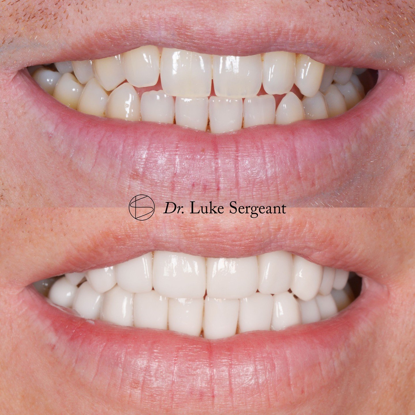 This client wanted a much brighter, more even and symmetrical smile, with minimal maintenance needed for the future. We achieved this through the use of tooth whitening, followed by a smile design for 10x upper and 10x lower Emax veneers. Whilst this