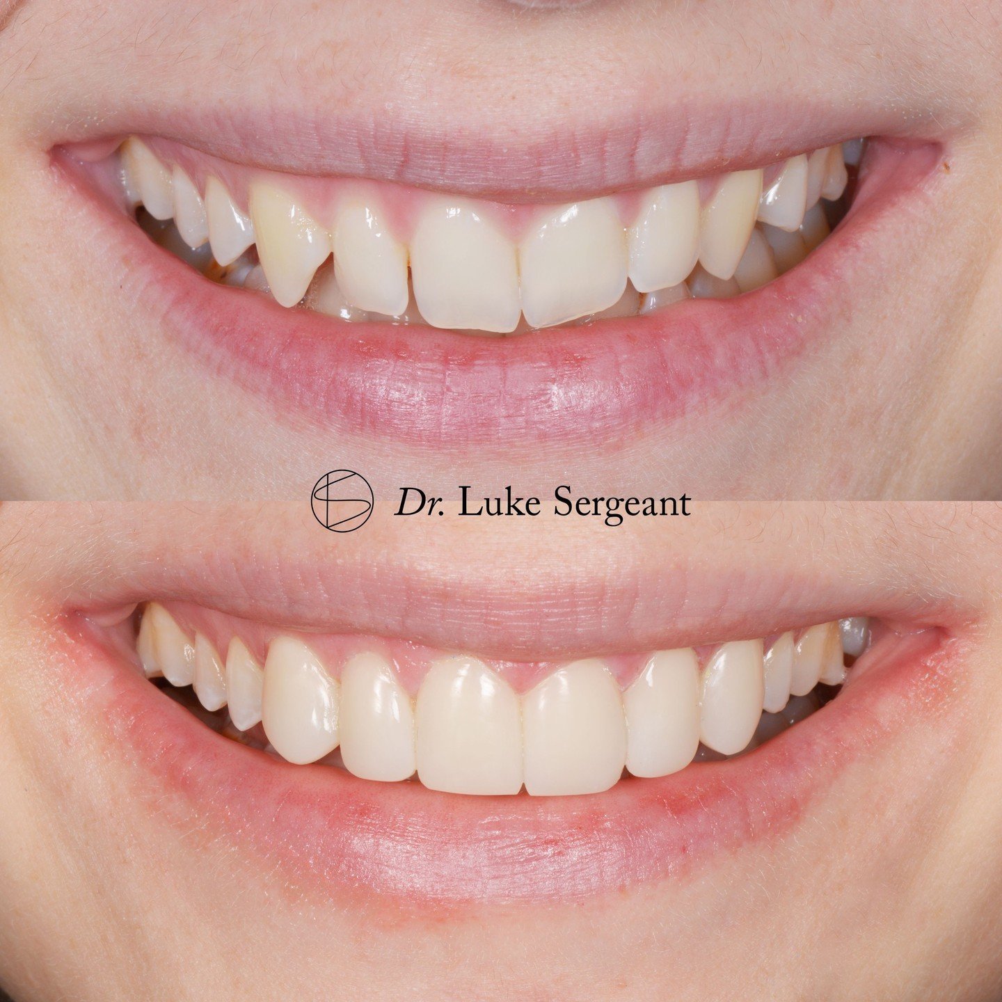 This client dreamt of a brighter, more even and symmetrical, fuller smile. We brought this to life with Invisalign and composite bonding! ✨

#compositeveneers #smiledesign #invisalign #smiletransformation