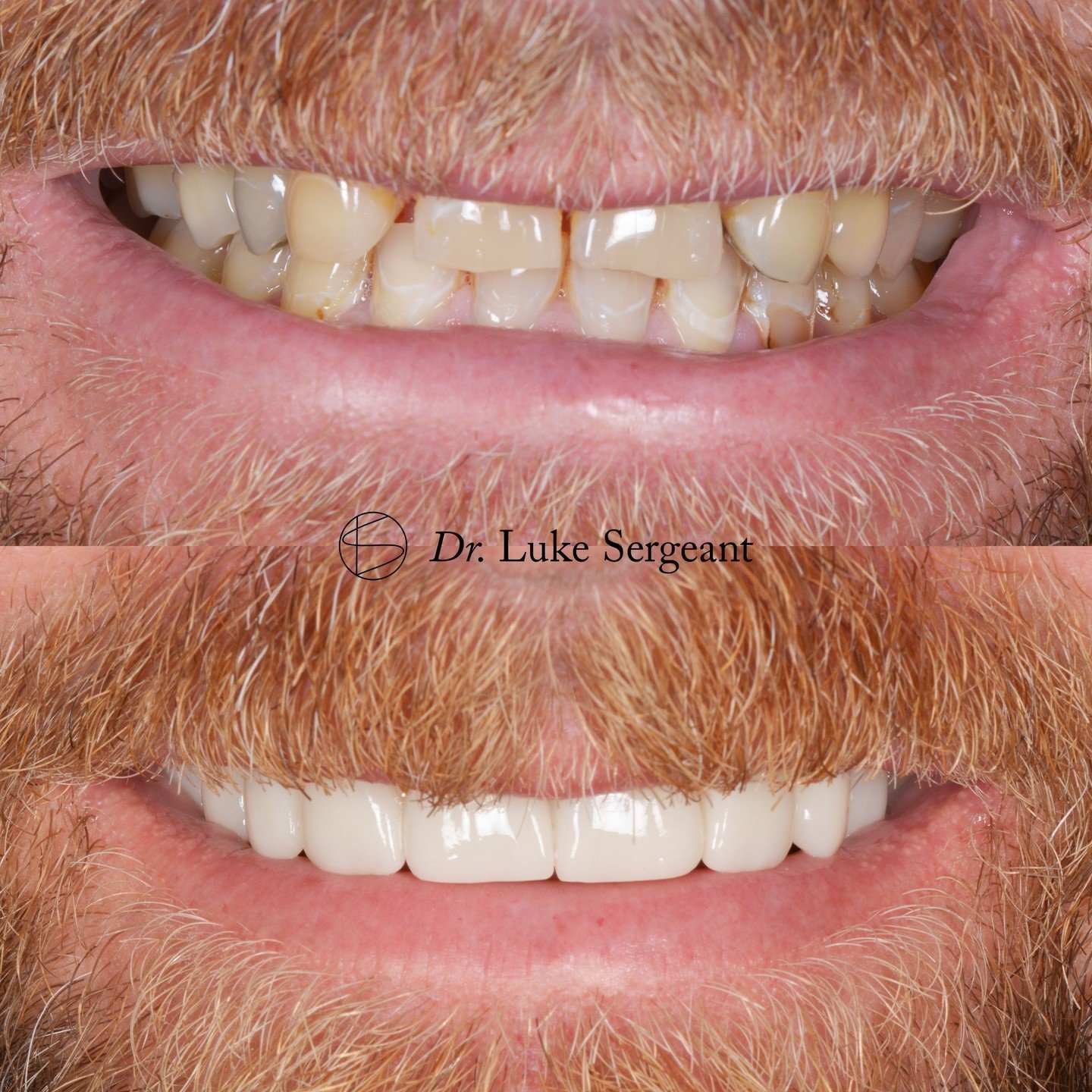 This amazing transformation was achieved using a combination of Emax veneers, and two Emax bridges, to replace missing teeth. Following tooth whitening and a smile design, to ensure the best symmetry, function and aesthetic possible. ✨

#emaxveneers 