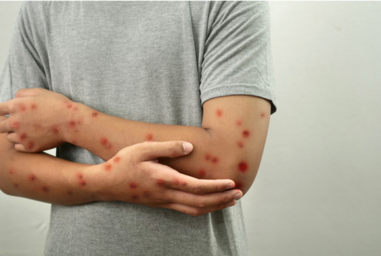 Mpox: Understanding the Threat and Strengthening Prevention with the KRAKEN™