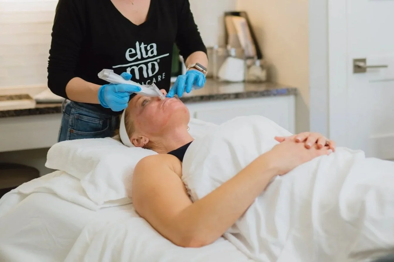 Facial microneedling with MicroPen EVO in Kerrville Texas
