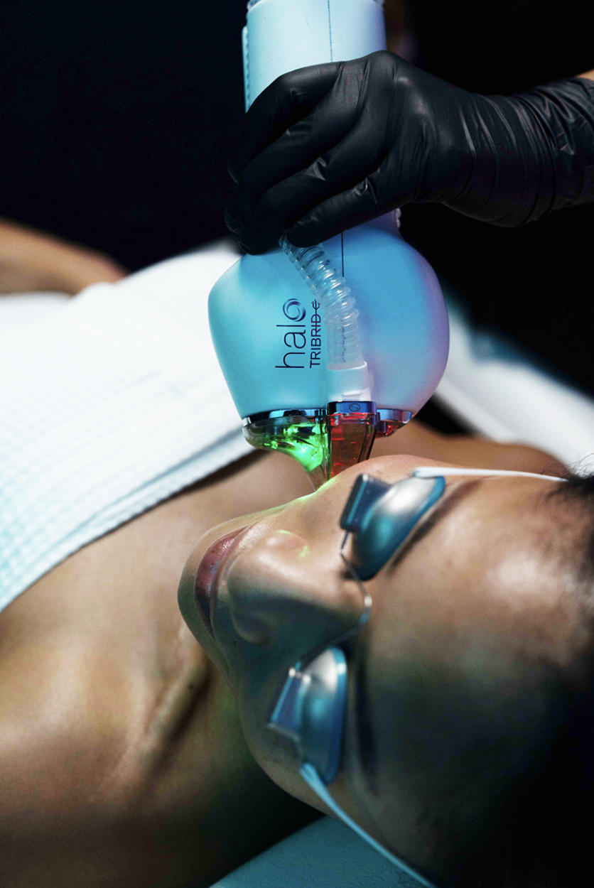O Young MD Kerrville Texas Halo Tribrid Laser