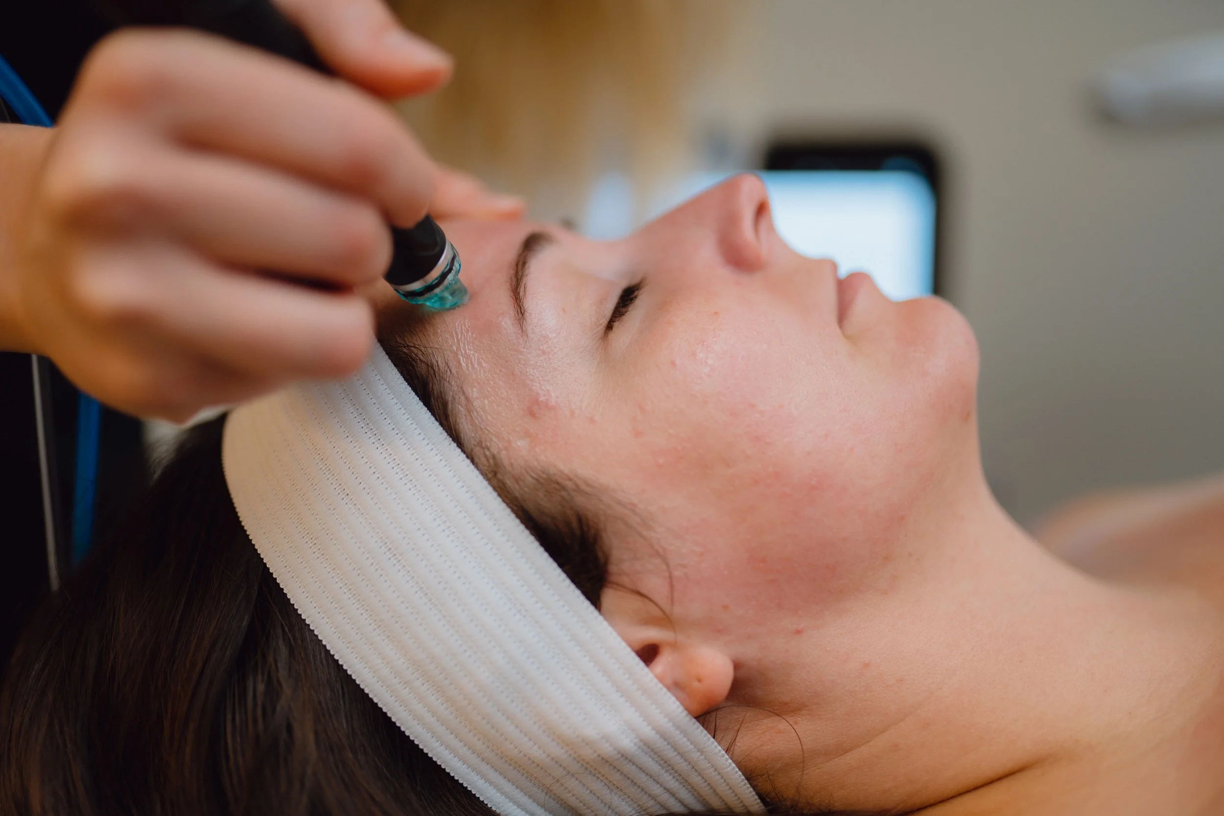 Hydrafacial Acne Treatment in Kerrville, Texas — O Young MD