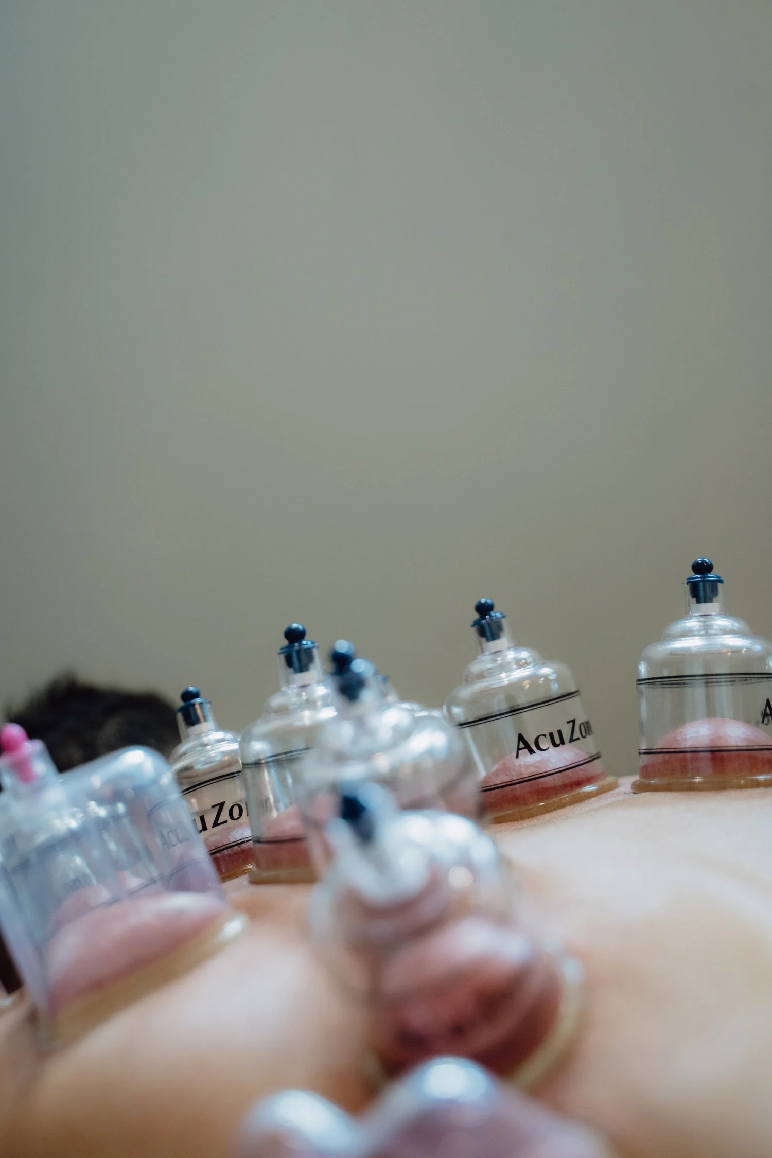 Cupping Massage in Kerrville, Texas — O Young MD