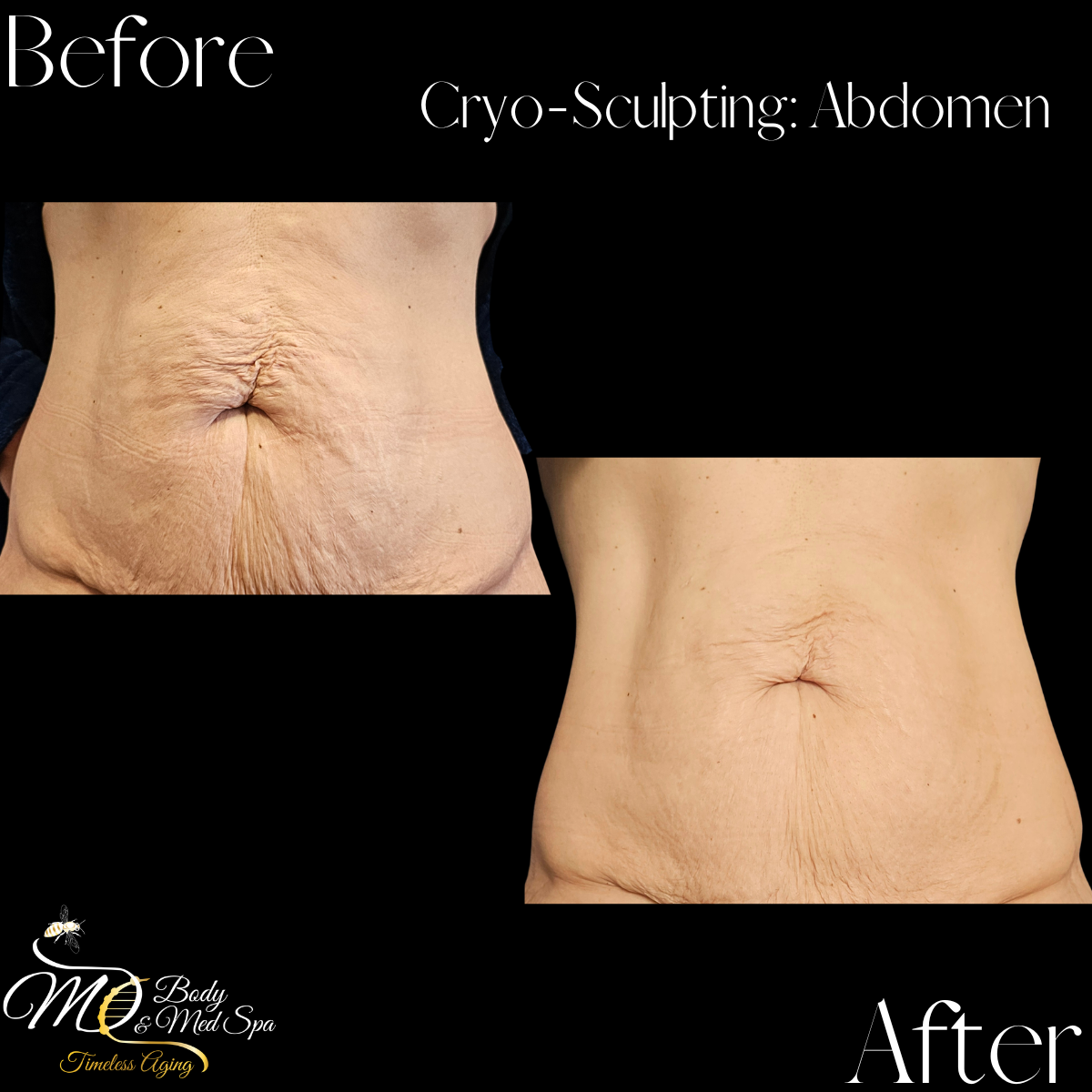 Before and after images of a person's abdomen showing the effects of cryo-sculpting, with noticeable skin tightening and reduced wrinkles in the after image.