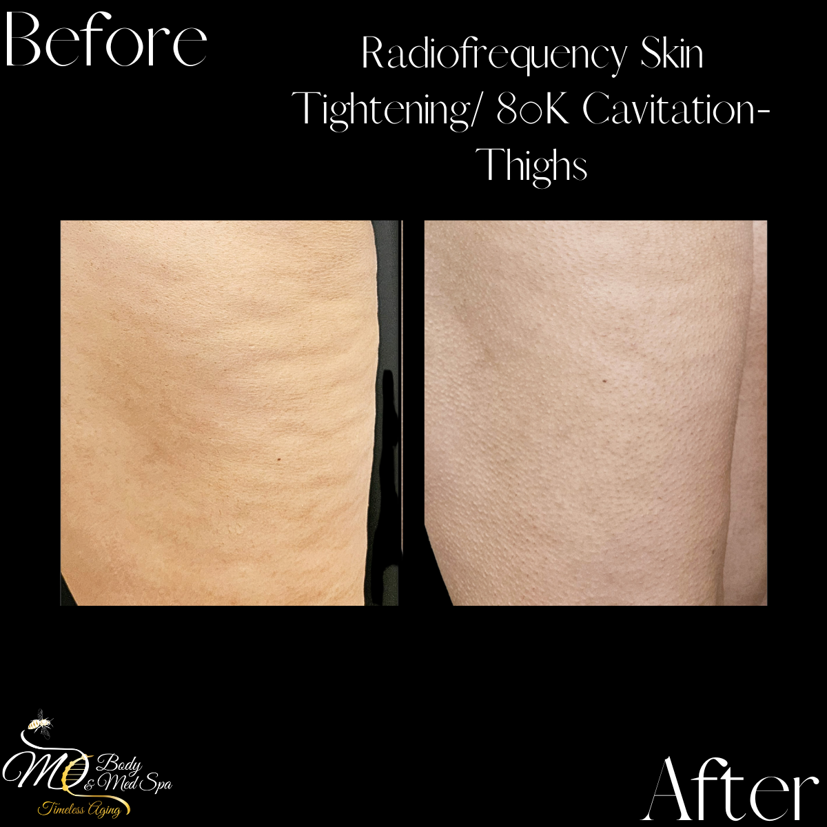 80K Cavitation Cellulite Reduction .png